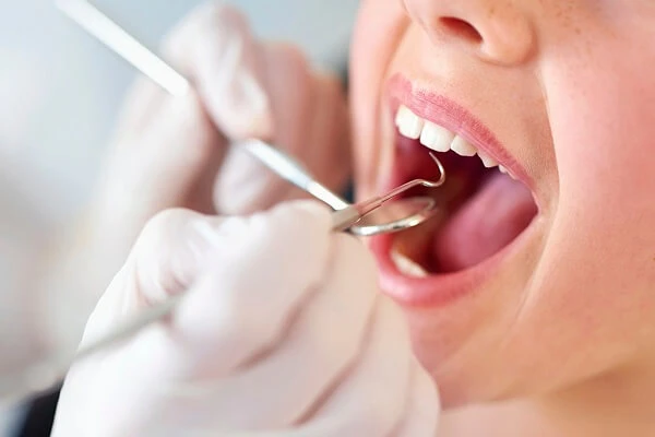 Lấy cao răng có giúp răng trắng hơn?